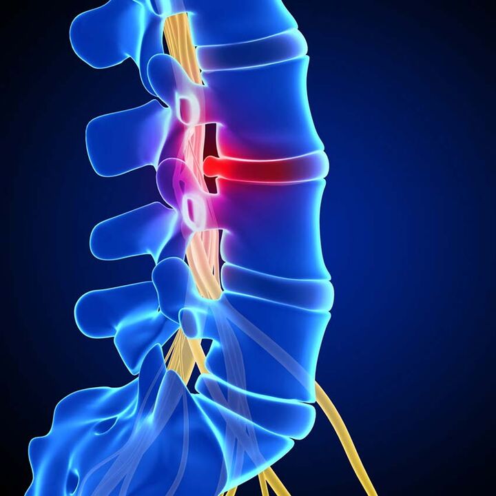 Osteocondroza simptomelor coloanei lombare și tratament